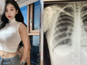 【GG扑克】[网络美女]韩国「百万网红」不满被质疑整形…晒X光照自证清白：我没有动过手术