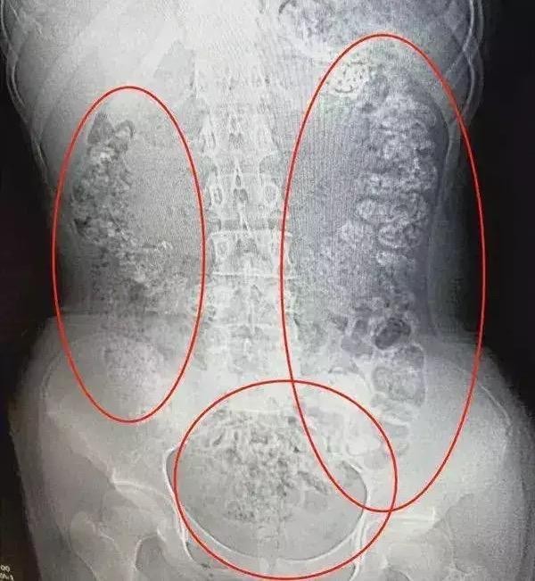 14岁女孩半夜看急诊，肚子胀鼓鼓的，医生：网红食物吃多了