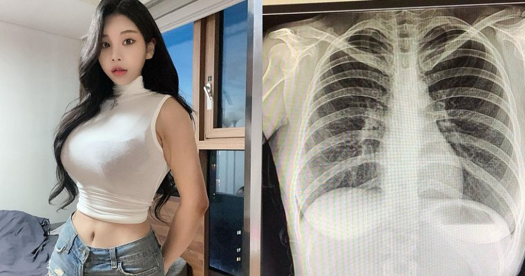 【GG扑克】南韓「百萬網紅」不滿被質疑整形…曬 X 光照自證清白：我沒有動過手術